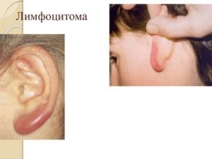 лимфоцитома