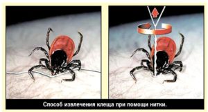 Извлечение клещей ниткой