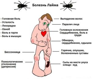 симптомы болезни Лайма